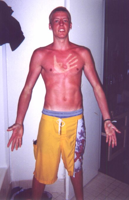 hetrick_sunburn[1].jpg
